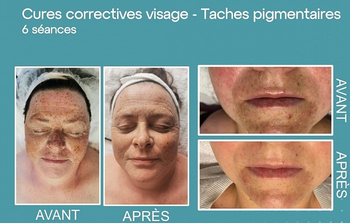 Soin anti tâche pigmentaires, masque de grossesse